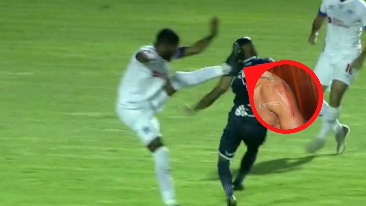 Revelan heridas del Chino López luego de la jugada con Elvin Casildo en el Superclásico