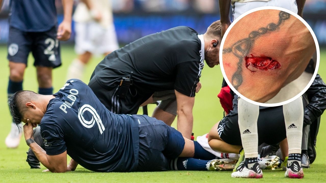 Mexicano muestra la terrible lesión que sufrió en la MLS y que lo podría alejar de la Copa Oro