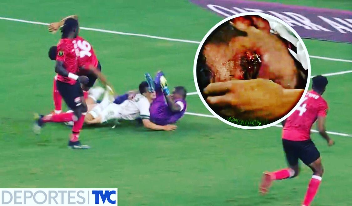 La terrible falta que dejó herido y con sangre al Chucky Lozano en el inicio de la Copa Oro 2021