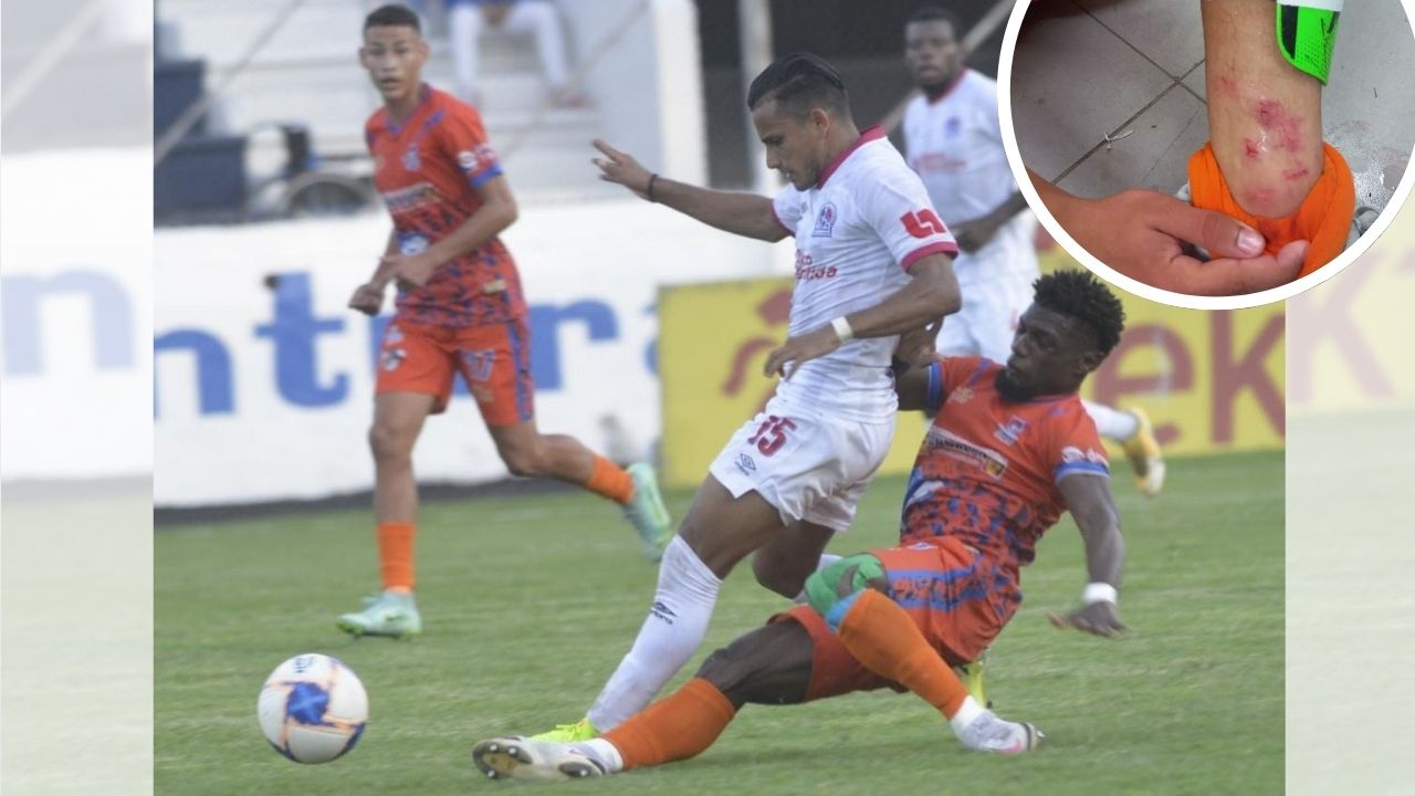 Lobos de la UPN muestra las lesiones que sufrieron dos de sus jugadores en el choque ante Olimpia
