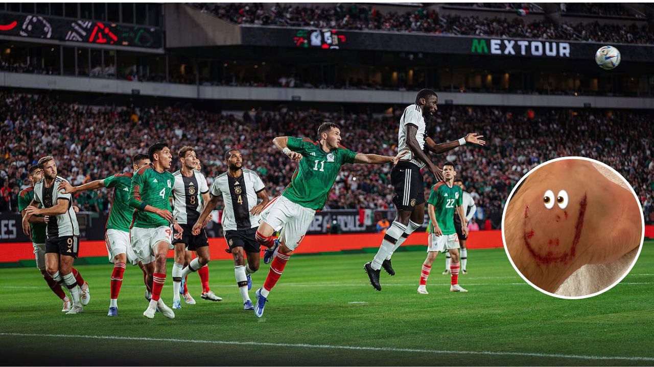 Jugador de Alemania compartió la herida que le quedó tras partido contra México