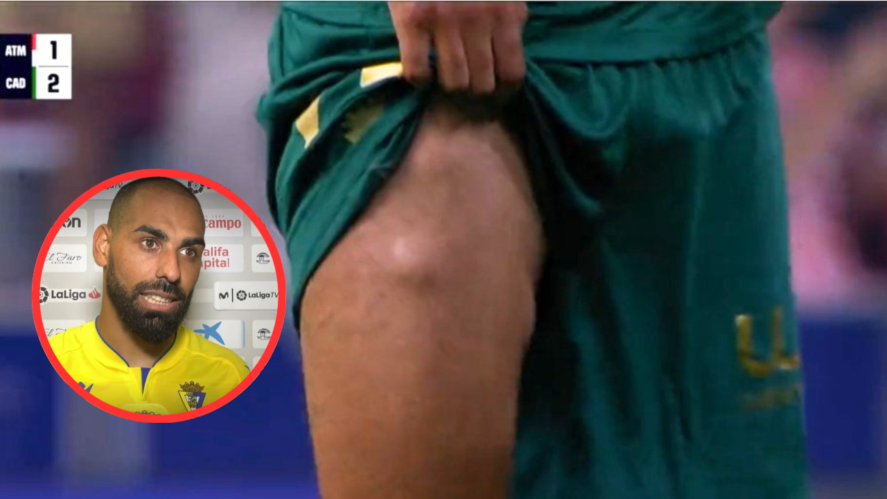 Esto es lo que causa los extraños bultos en la pierna de Fali jugador del Cadíz