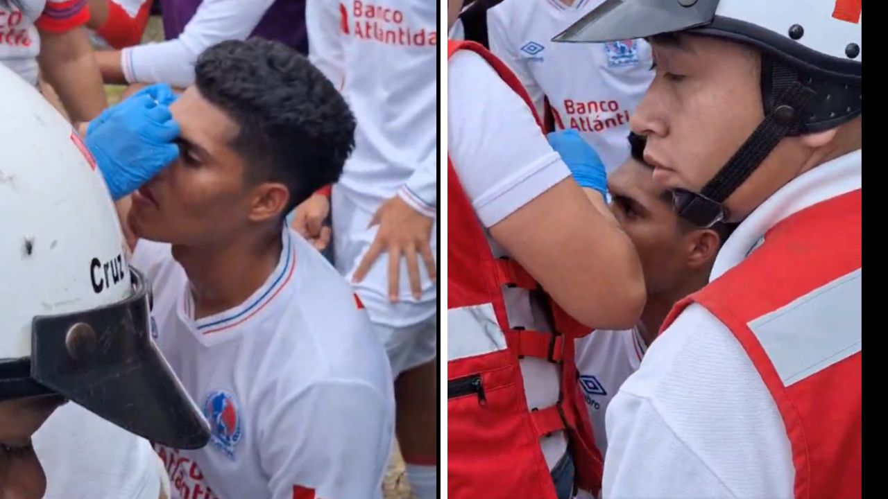Lamentable: Así quedó el rostro de un futbolista del Olimpia tras pelea en final de Reservas
