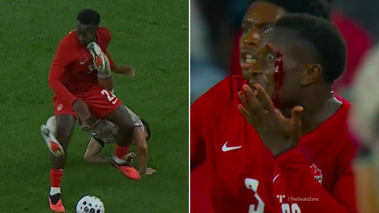 Así le quedó la cara a Richie Laryea tras recibir una patada en el Canadá vs Chile